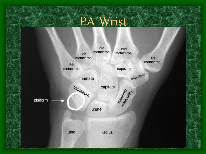 PA Wrist 