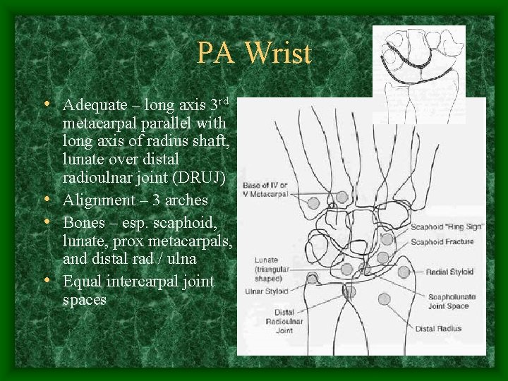 PA Wrist • Adequate – long axis 3 rd metacarpal parallel with long axis
