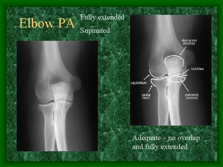 Elbow PA Fully extended Supinated Adequate – no overlap and fully extended 