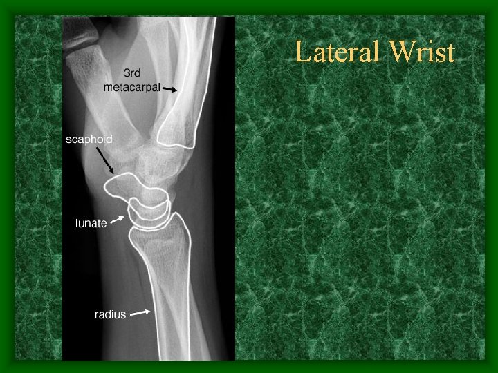 Lateral Wrist 