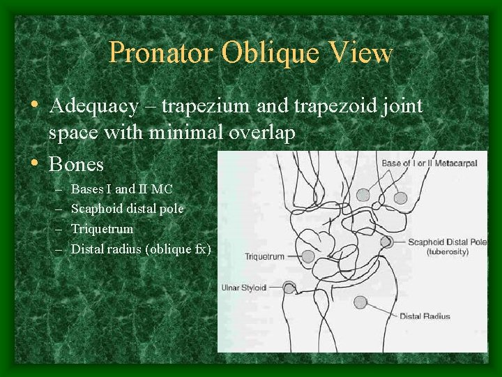 Pronator Oblique View • Adequacy – trapezium and trapezoid joint space with minimal overlap