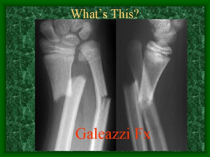 What’s This? Galeazzi Fx 