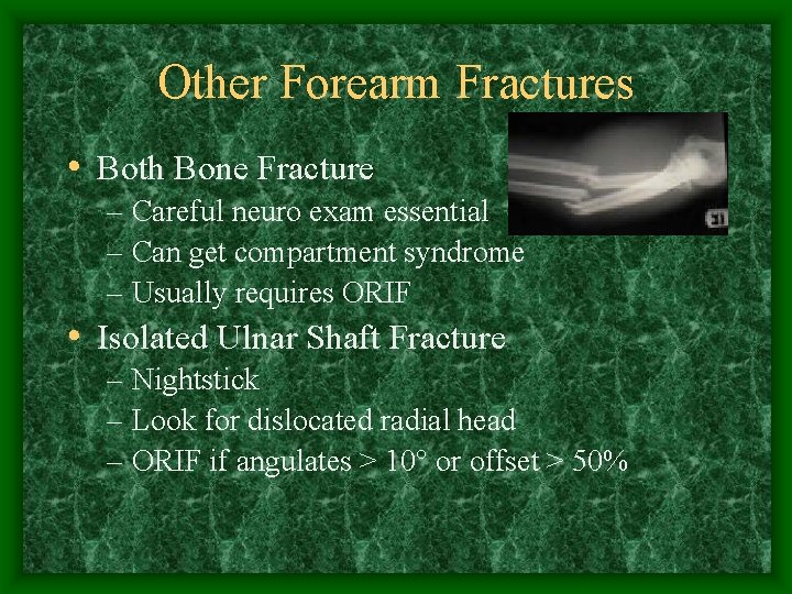 Other Forearm Fractures • Both Bone Fracture – Careful neuro exam essential – Can