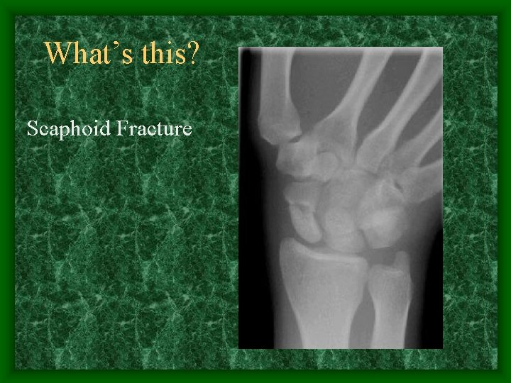 What’s this? Scaphoid Fracture 