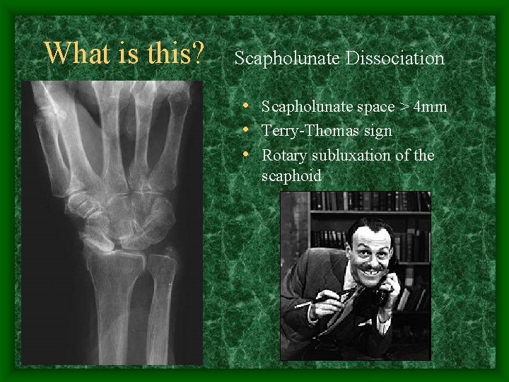 What is this? Scapholunate Dissociation • Scapholunate space > 4 mm • Terry-Thomas sign
