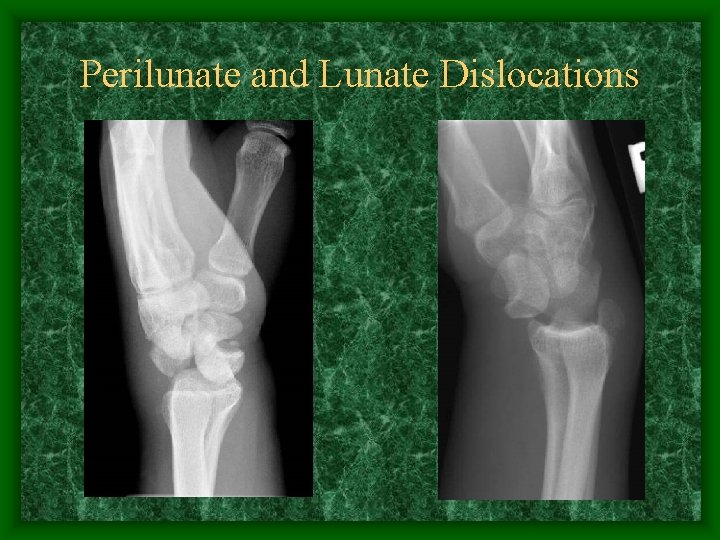 Perilunate and Lunate Dislocations 