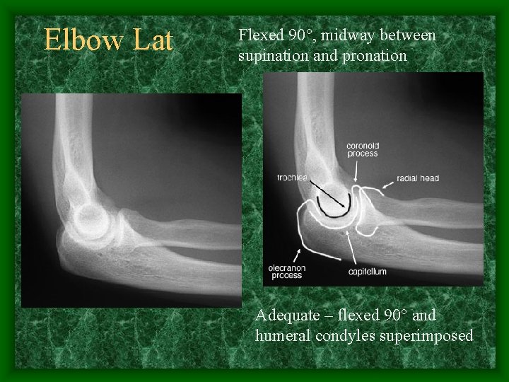 Elbow Lat Flexed 90°, midway between supination and pronation Adequate – flexed 90° and
