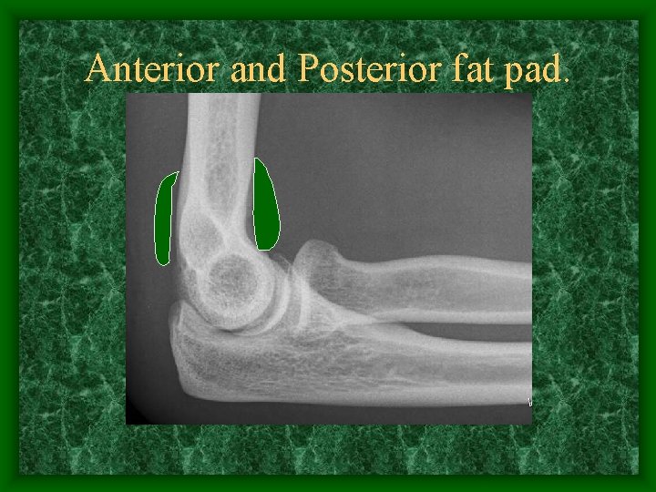 Anterior and Posterior fat pad. 
