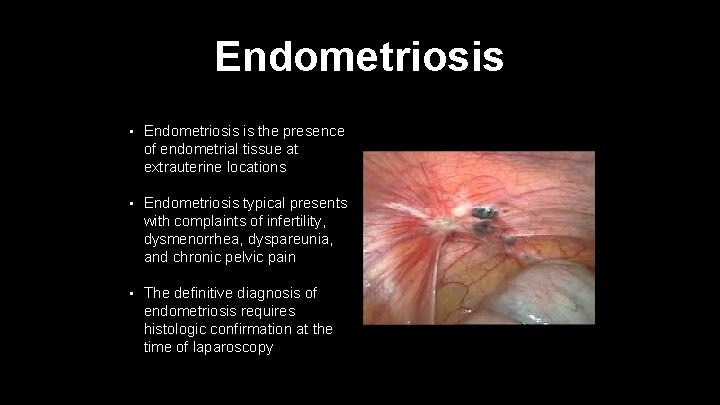 Endometriosis • Endometriosis is the presence of endometrial tissue at extrauterine locations • Endometriosis