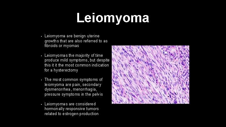 Leiomyoma • Leiomyoma are benign uterine growths that are also referred to as fibroids