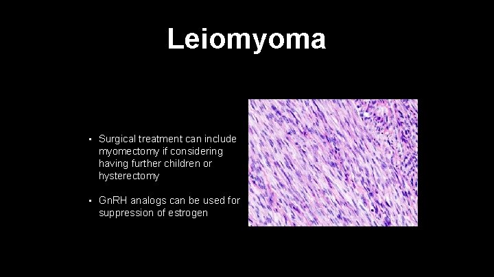Leiomyoma • Surgical treatment can include myomectomy if considering having further children or hysterectomy