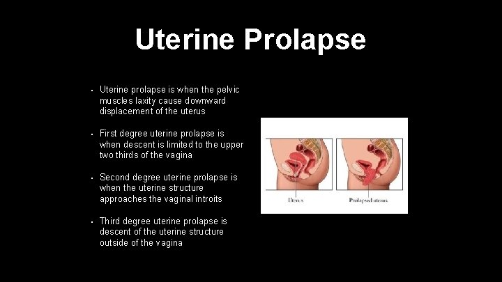 Uterine Prolapse • Uterine prolapse is when the pelvic muscles laxity cause downward displacement