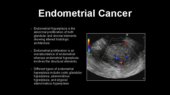Endometrial Cancer • Endometrial Hyperplasia is the abnormal proliferation of both glandular and stromal