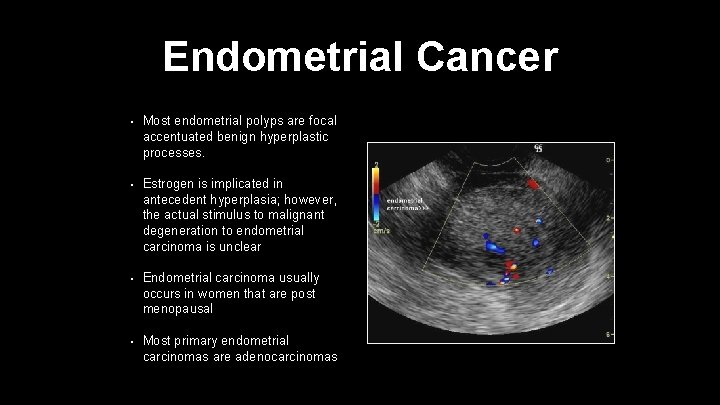 Endometrial Cancer • Most endometrial polyps are focal accentuated benign hyperplastic processes. • Estrogen