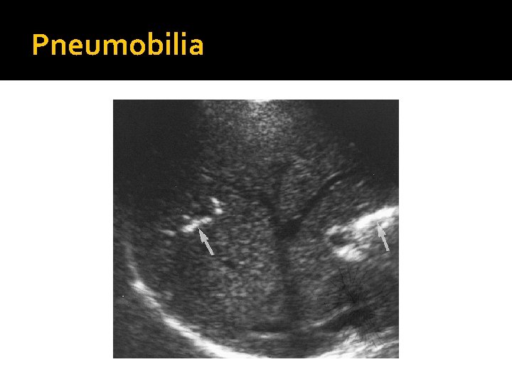 Pneumobilia 