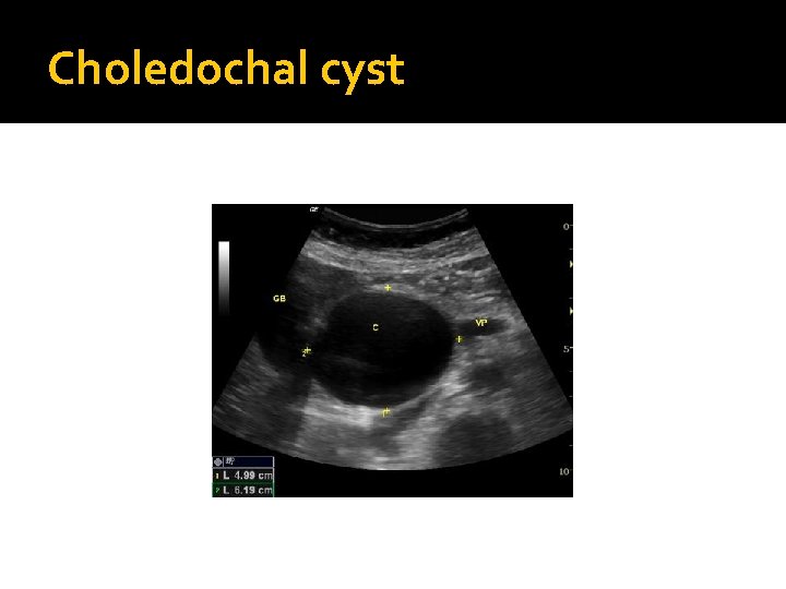 Choledochal cyst 