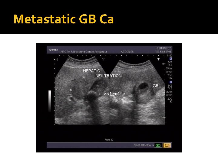 Metastatic GB Ca 