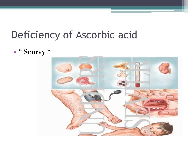 Deficiency of Ascorbic acid • “ Scurvy “ 