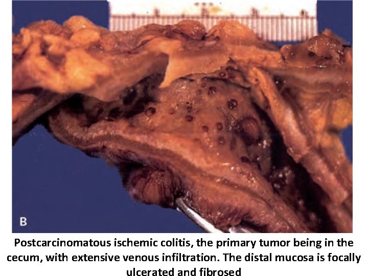 Postcarcinomatous ischemic colitis, the primary tumor being in the cecum, with extensive venous infiltration.