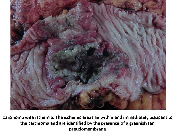 Carcinoma with ischemia. The ischemic areas lie within and immediately adjacent to the carcinoma
