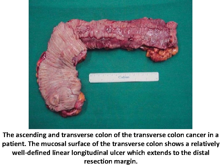 The ascending and transverse colon of the transverse colon cancer in a patient. The
