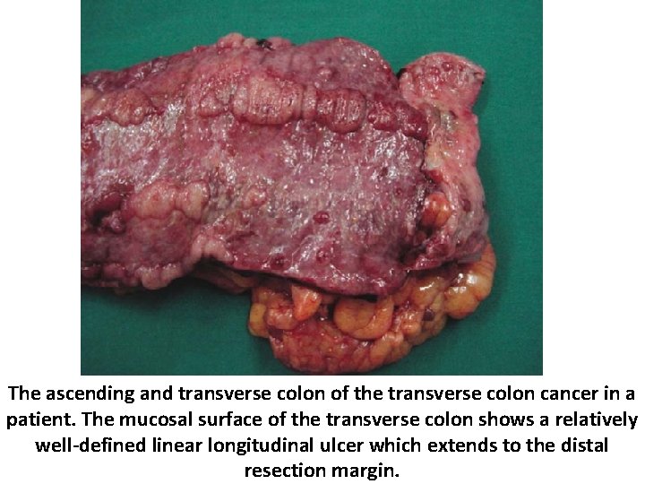 The ascending and transverse colon of the transverse colon cancer in a patient. The