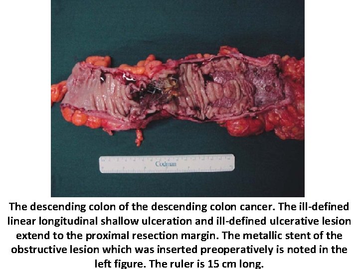 The descending colon of the descending colon cancer. The ill-defined linear longitudinal shallow ulceration