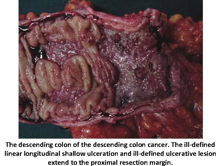 The descending colon of the descending colon cancer. The ill-defined linear longitudinal shallow ulceration
