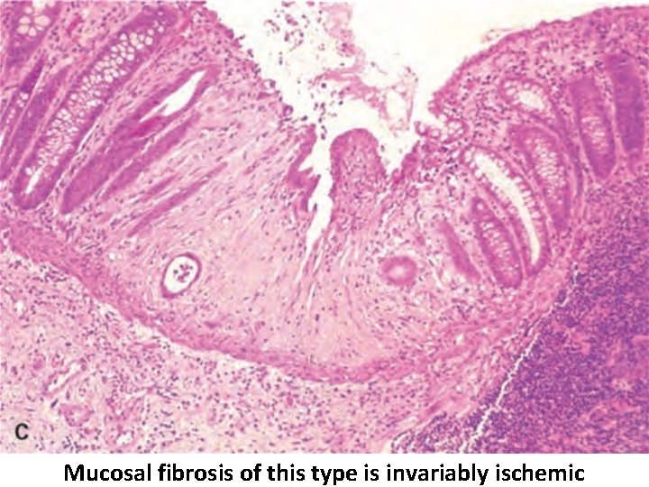 Mucosal fibrosis of this type is invariably ischemic 