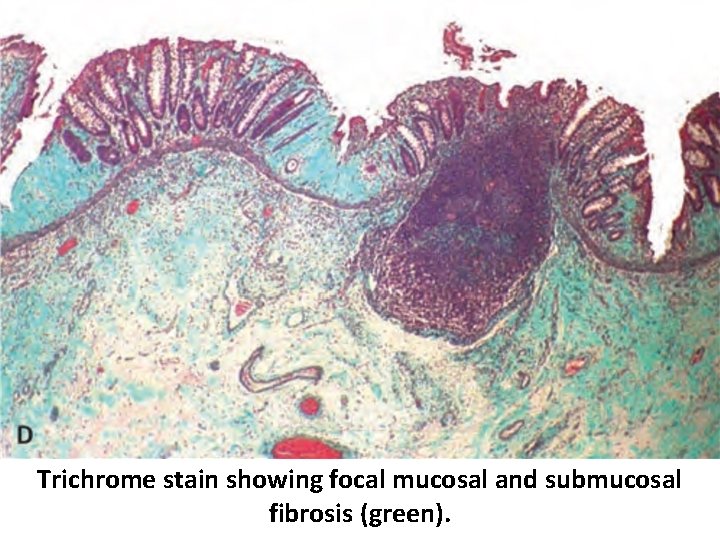 Trichrome stain showing focal mucosal and submucosal fibrosis (green). 