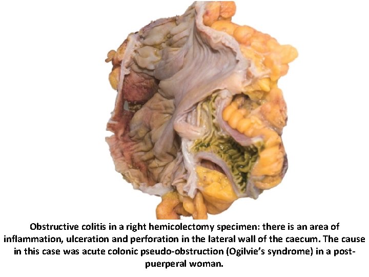 Obstructive colitis in a right hemicolectomy specimen: there is an area of inflammation, ulceration