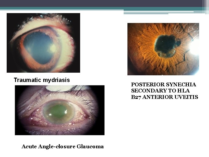 Traumatic mydriasis Acute Angle-closure Glaucoma POSTERIOR SYNECHIA SECONDARY TO HLA B 27 ANTERIOR UVEITIS