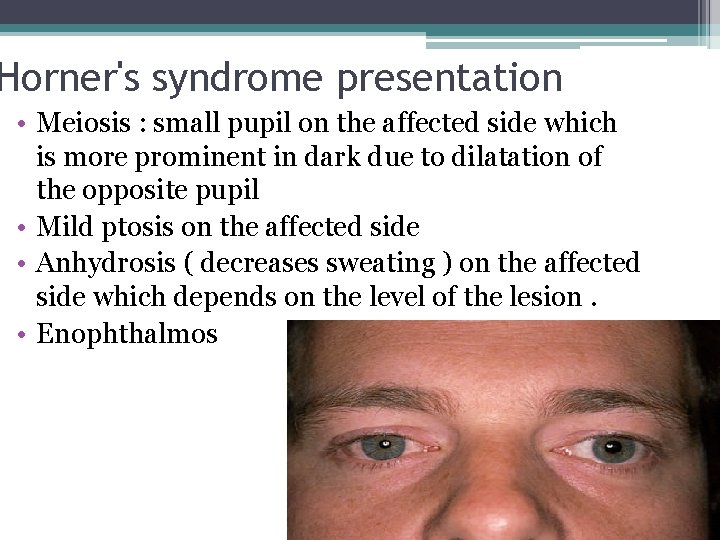 Horner's syndrome presentation • Meiosis : small pupil on the affected side which is