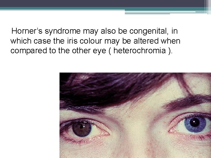 Horner’s syndrome may also be congenital, in which case the iris colour may be