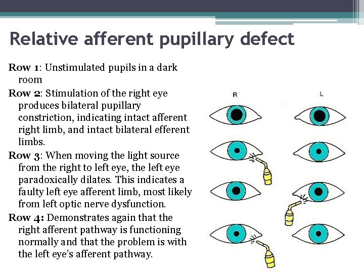 Relative afferent pupillary defect Row 1: Unstimulated pupils in a dark room Row 2: