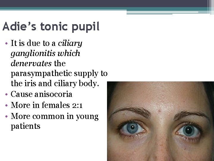 Adie’s tonic pupil • It is due to a ciliary ganglionitis which denervates the