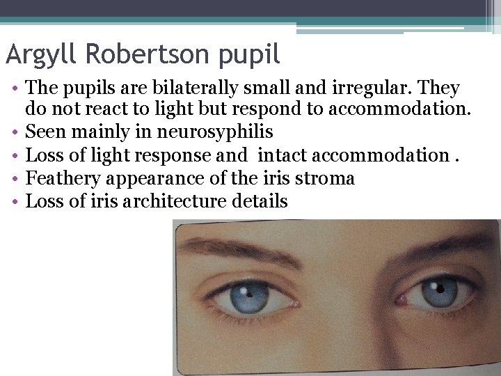 Argyll Robertson pupil • The pupils are bilaterally small and irregular. They do not