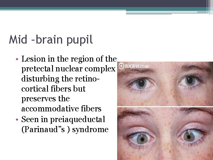 Mid –brain pupil • Lesion in the region of the pretectal nuclear complex disturbing