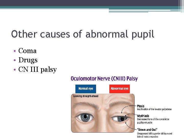 Other causes of abnormal pupil • Coma • Drugs • CN III palsy 