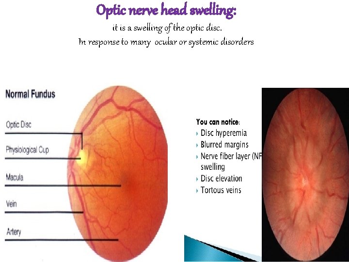 Optic nerve head swelling: it is a swelling of the optic disc. In response