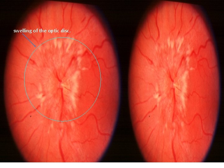 swelling of the optic disc. 