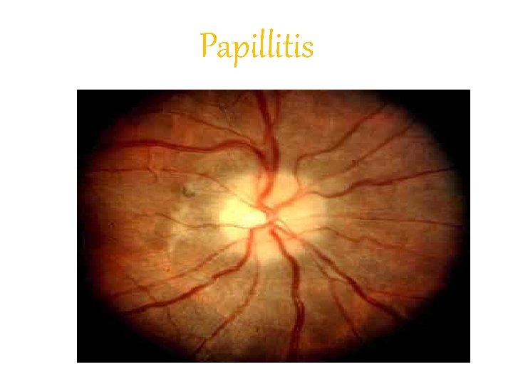 Papillitis 