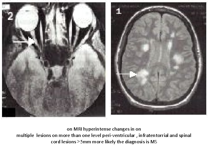 on MRI hyperintense changes in on multiple lesions on more than one level peri-ventricular