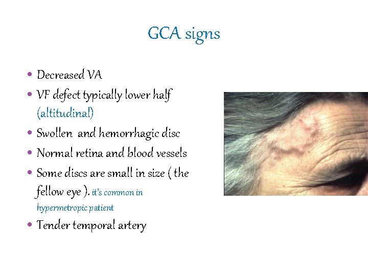 GCA signs • Decreased VA • VF defect typically lower half (altitudinal) • Swollen