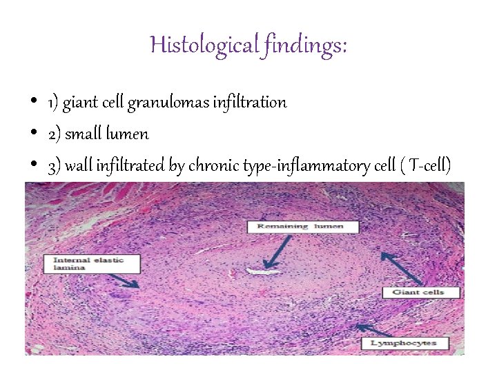 Histological findings: • 1) giant cell granulomas infiltration • 2) small lumen • 3)