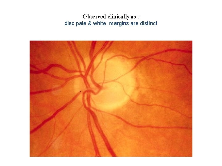Observed clinically as : disc pale & white, margins are distinct 