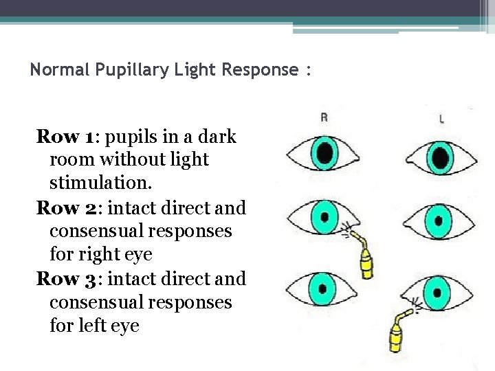 Normal Pupillary Light Response : Row 1: pupils in a dark room without light