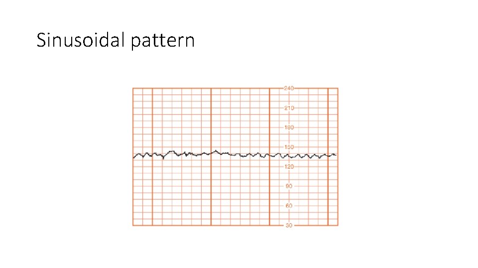 Sinusoidal pattern 