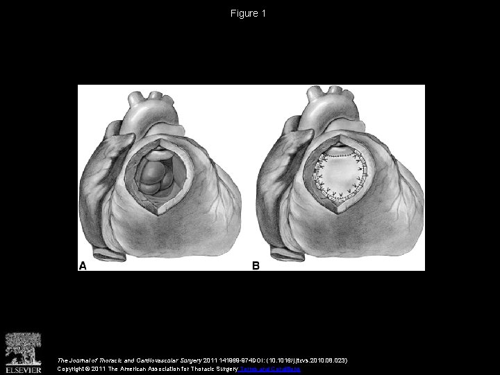 Figure 1 The Journal of Thoracic and Cardiovascular Surgery 2011 141969 -974 DOI: (10.