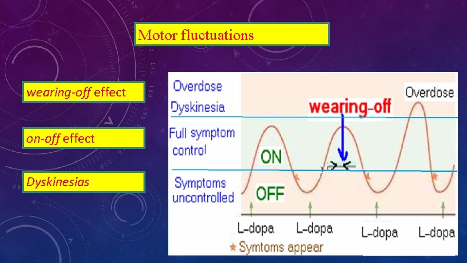 Motor fluctuations wearing-off effect on-off effect Dyskinesias 